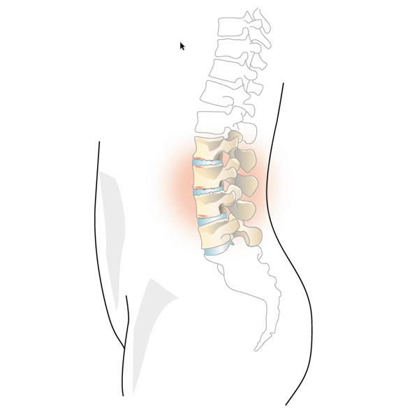 Verschleiß Der Lendenwirbelsäule - Lumbarosteoarthritis - Wirbelsäule ...