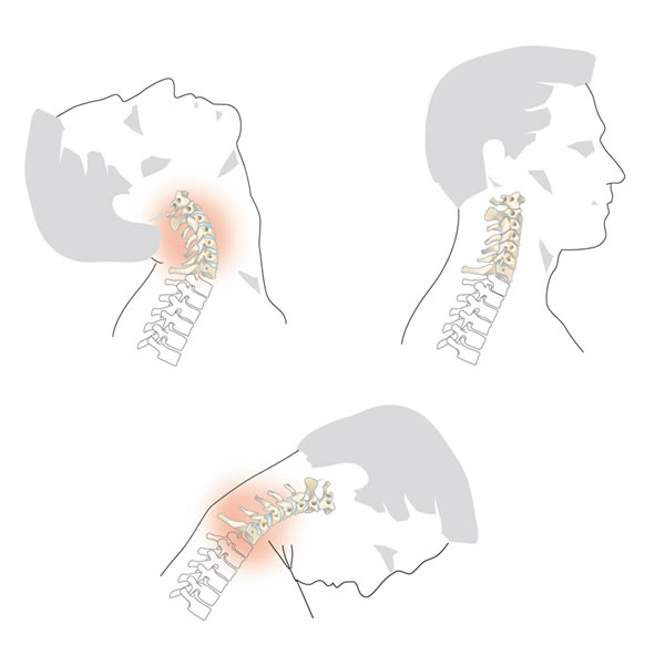 Schleudertrauma - Wirbelsaule - Verletzungen - Push Braces